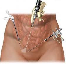 Power Morcellation in Uterine Surgery